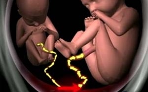 Cặp song sinh sống sót sau hội chứng hiếm gặp