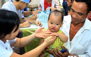 300 trẻ em dị tật hở môi sẽ được phẫu thuật miễn phí