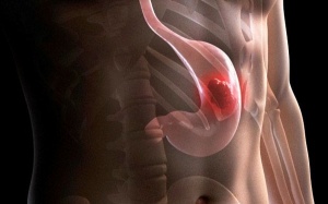 Ung thư dạ dày: Có thể điều trị bằng tiêm Botox