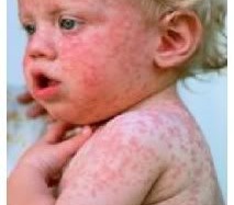 Bệnh sởi và bệnh rubella: những điều mẹ cần biết
