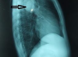 Kinh hãi hàng nghìn đầu sán chó trong u phổi bệnh nhân