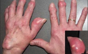Gout – Nguy hiểm khi biến chứng