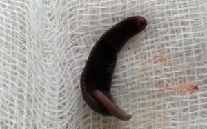 Gắp con vắt dài 4cm từ mũi bệnh nhi