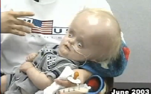 Cậu bé không có bán cầu não qua đời ở tuổi 12