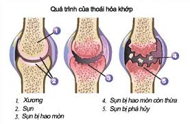 Thoái hóa khớp: Bắt đầu từ tuổi 40