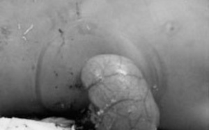 Cứu bé trai người Campuchia bị trâu húc lòi ruột