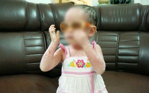 Phát hiện bệnh nhân mắc bệnh vảy cá hiếm gặp