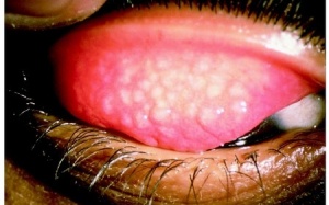 6 khuyến cáo phòng, chống bệnh đau mắt đỏ