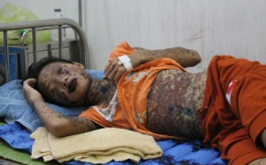 Cứu sống bệnh nhi bị bỏng do dị ứng thuốc