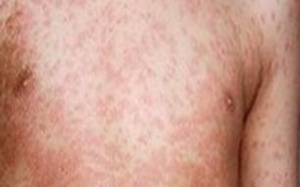 Sởi ở người lớn: Khó phát hiện và dễ có biến chứng