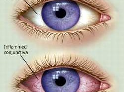 Chưa có thuốc điều trị đặc hiệu cho bệnh đau mắt đỏ