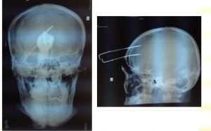 Đuổi bắt trộm chó bị bắn chĩa gim giữa trán