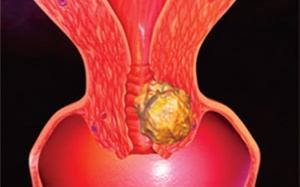 7 phụ nữ Việt chết vì ung thư cổ tử cung mỗi ngày