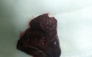 Phẫu thuật thành công ca vỡ lách giãn đồng tử