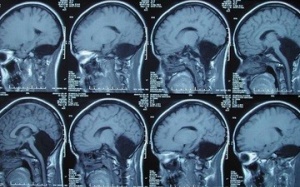 Sống bình thường hơn 20 năm dù không có tiểu não