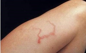 Kinh hãi giun lươn loằng ngoằng dưới da