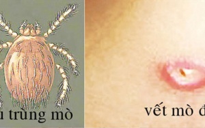 Sốt mò: Có thể tử vong nếu không phát hiện kịp thời