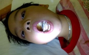 Ngậm phích điện, bé trai bị cháy lưỡi