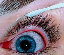 Hà Nội: Gần 2.000 trường hợp đau mắt đỏ