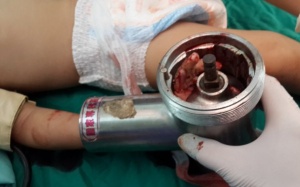 Nát bàn tay do nghịch máy xay thịt