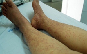 Nhập viện do uống thuốc của thầy lang