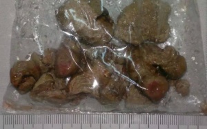 Gắp viên sỏi kích thước lớn trong thận bệnh nhân