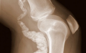 Protein dạng GILZ giúp bảo vệ xương trước bệnh viêm khớp