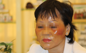 Nhập viện vì dùng phải mỹ phẩm giả