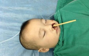 Đùa nghịch, bé trai 2 tuổi bị đũa chọc từ mũi lên não