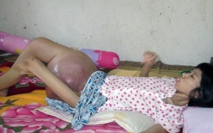 Xót xa người phụ nữ có khối u nặng gần 10kg ở đùi