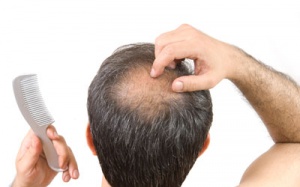 Nam giới hói đầu có nguy cơ cao bị ung thư tuyến tiền liệt