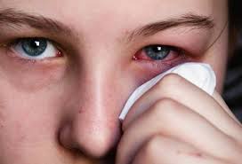 Đau mắt đỏ “hoành hành”: Một người mắc hai người lo