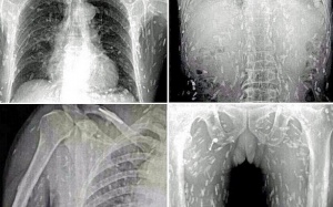 Suýt mất mạng vì ăn sushi chứa trứng sán