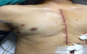 Viên đạn nằm trong tim suốt 2 tháng vẫn sống