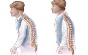 Ăn gì để tránh loãng xương?