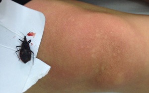 Hà Nội: Một bệnh nhân nhập viện do bọ xít hút máu cắn