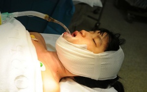 Phẫu thuật bóc khối u quái trong miệng bệnh nhân