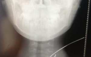 Cứu sống bệnh nhân bị cọng sắt bắn xuyên cổ