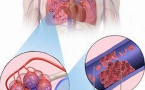 Cứu sống bệnh nhi không có động mạch phổi phải