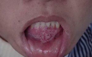 Sủi mào gà có thể lây khi hôn nhau