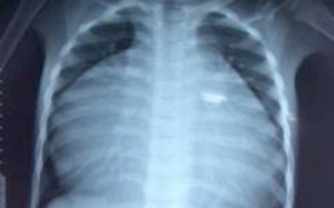 ​Phẫu thuật trẻ bị phình tâm nhĩ phải hiếm gặp