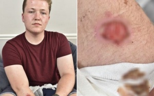 Bỏng cánh tay do iPhone 5