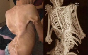 800 người mắc hội chứng hóa đá