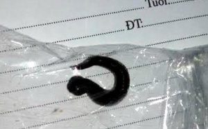 Kinh hãi đỉa sống trong thanh quản bệnh nhi