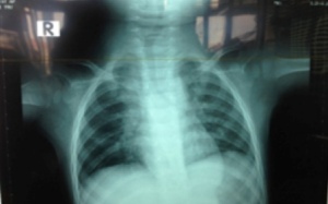 Trẻ nguy kịch vì hạt mãng cầu gây tắc phế quản