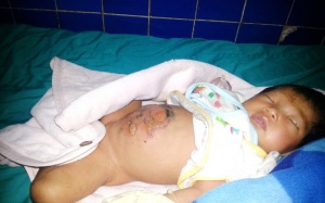 Bé sơ sinh bỏng nặng do bà ngoại đắp lá