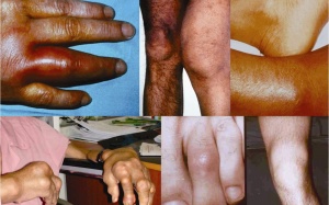 Cứng khớp – Dấu hiệu của “tàn phế”