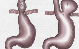 Cụ ông khốn khổ vì dạ dày nằm trên... ngực