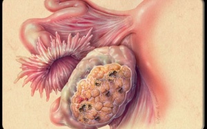 Băng vệ sinh giúp phát hiện ung thư buồng trứng