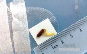 Phát hiện hạt thóc mọc mầm ngay trong mắt